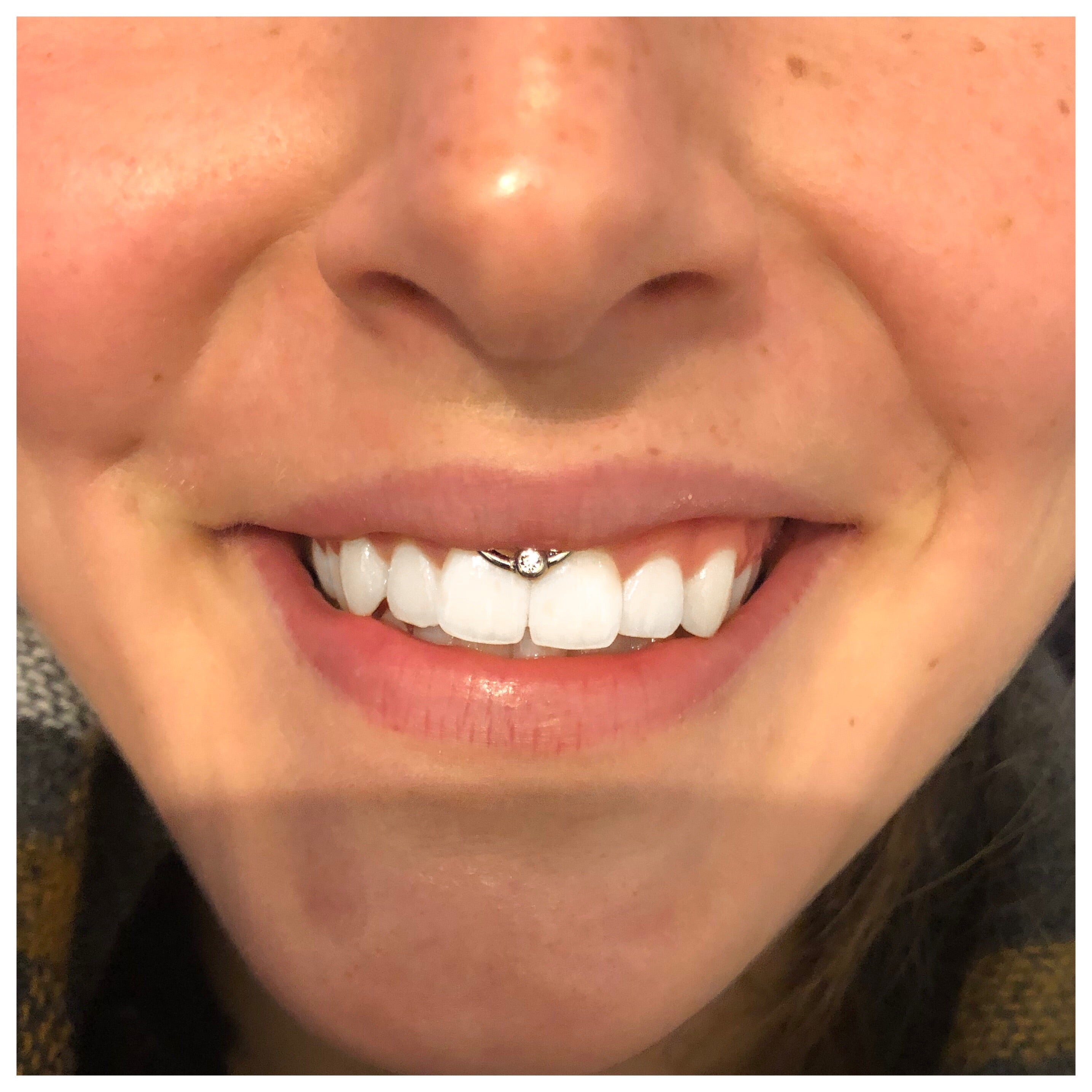 Lippenbändchen